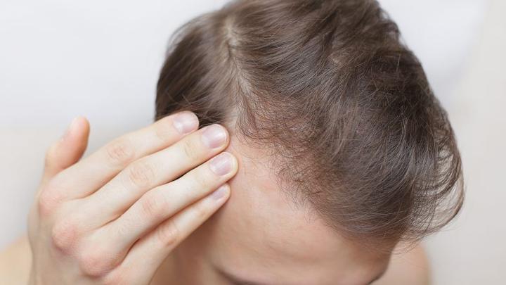 Przyczyny wypadania włosów